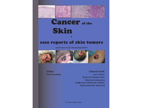 Cancer of the Skin - case reports of skin tumors