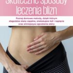 Skuteczne sposoby leczenia blizn — okładka e-booka