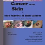 Tytuł: Cancer of the Skin - case reports of skin tumors
Autor: Piotr Brzezinski
Wydawnictwo: Our Dermatology Online
Formaty: EPUB, PDF