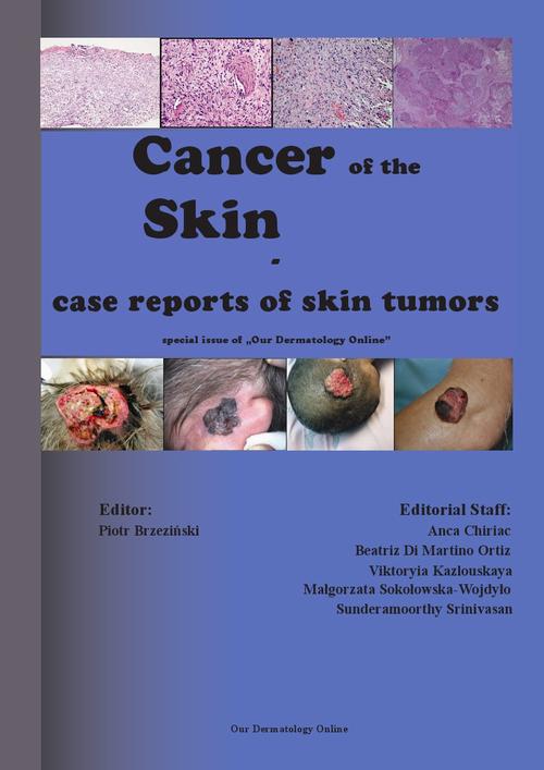 Tytuł: Cancer of the Skin - case reports of skin tumors
Autor: Piotr Brzezinski
Wydawnictwo: Our Dermatology Online
Formaty: EPUB, PDF